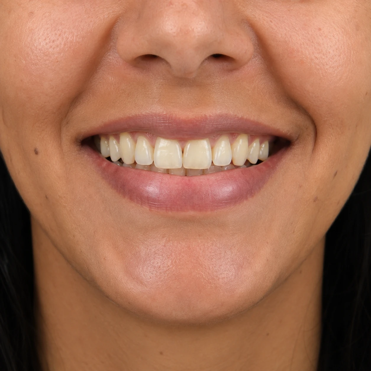 Sorriso antes do tratamento com lentes de contato dental, com dentes escurecidos e desalinhados