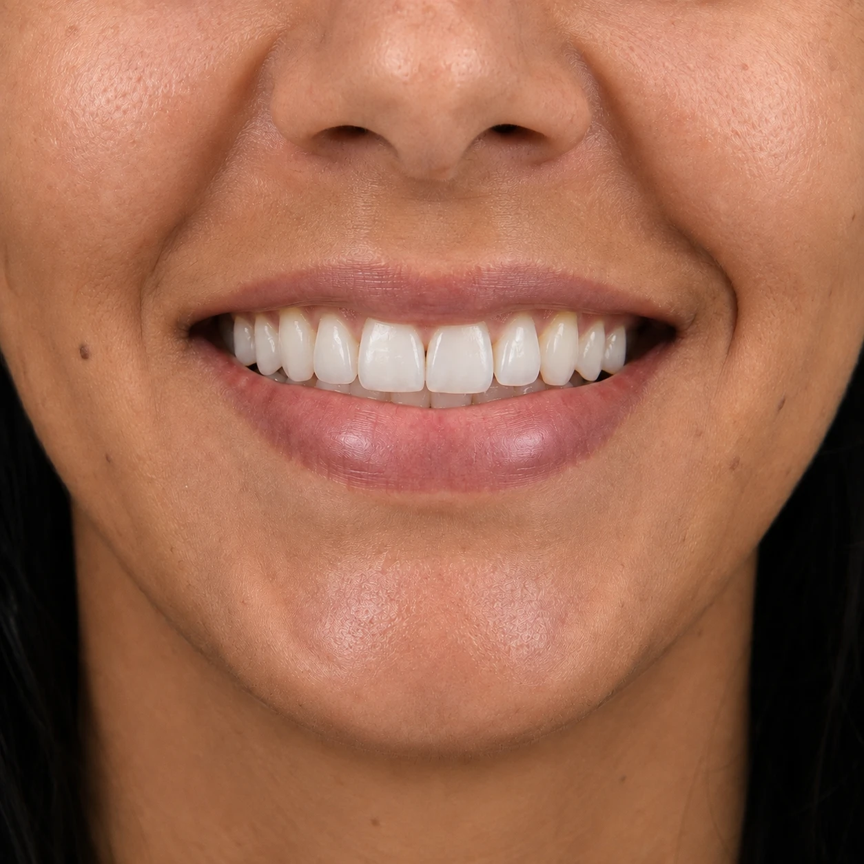 Sorriso depois do tratamento com lentes de contato dental, com forma e cor uniformes