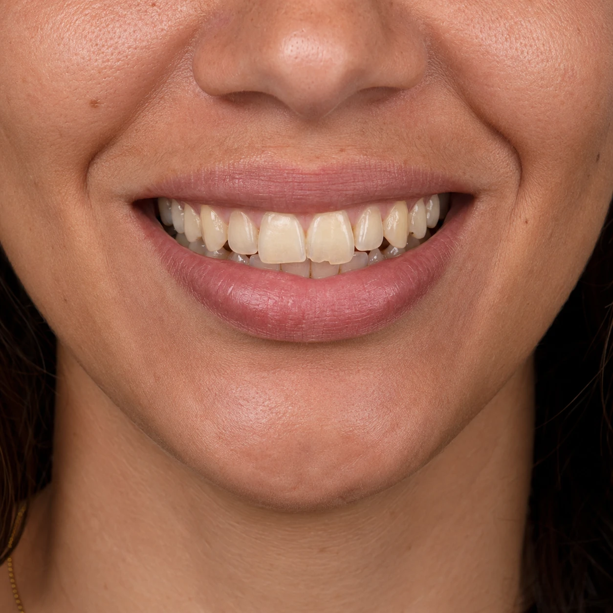 Sorriso antes das facetas de porcelana, com desgaste nas bordas dos dentes anteriores