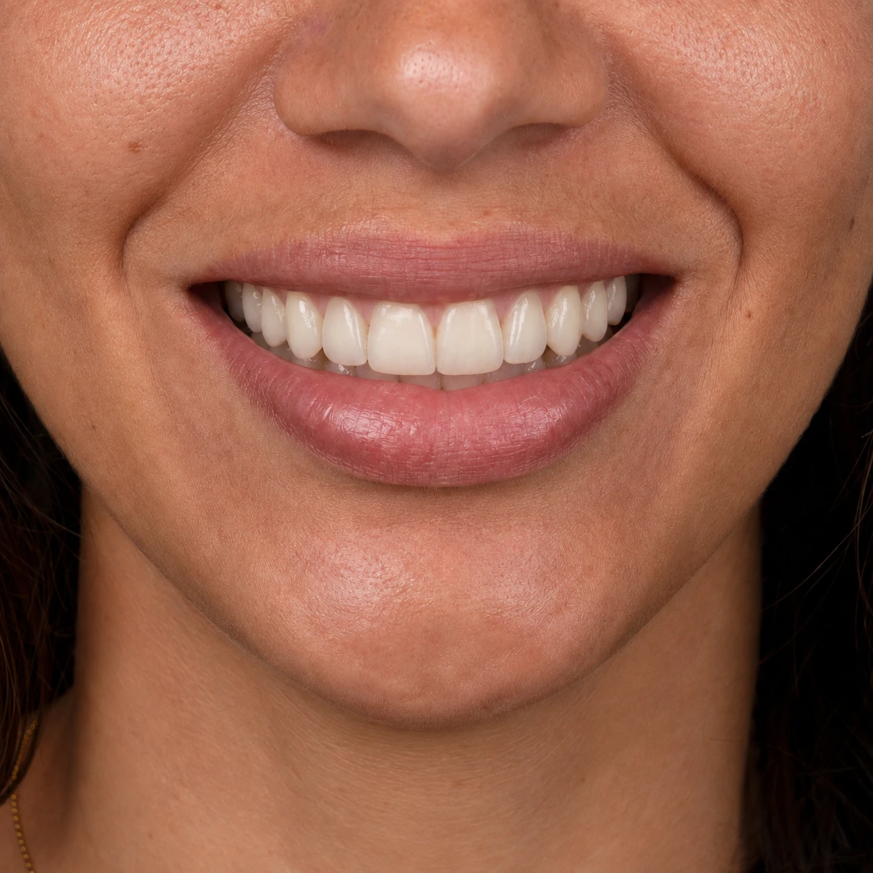 Sorriso depois das facetas de porcelana, com bordas reconstruídas e alinhamento harmônico