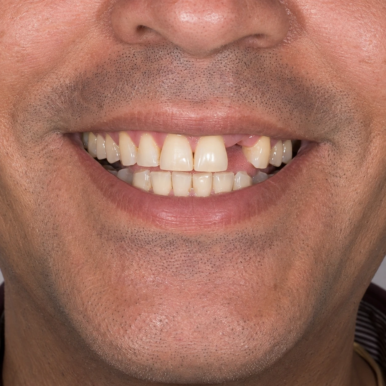 Sorriso antes da reabilitação com implante, com ausência de um dente anterior
