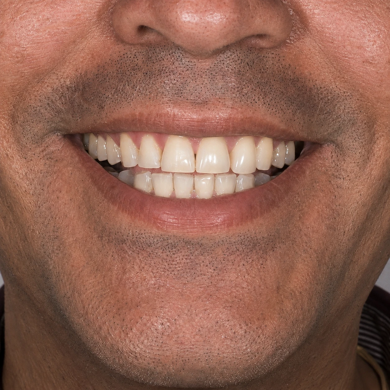 Sorriso depois da reabilitação com implante e coroa de porcelana no lugar do dente ausente