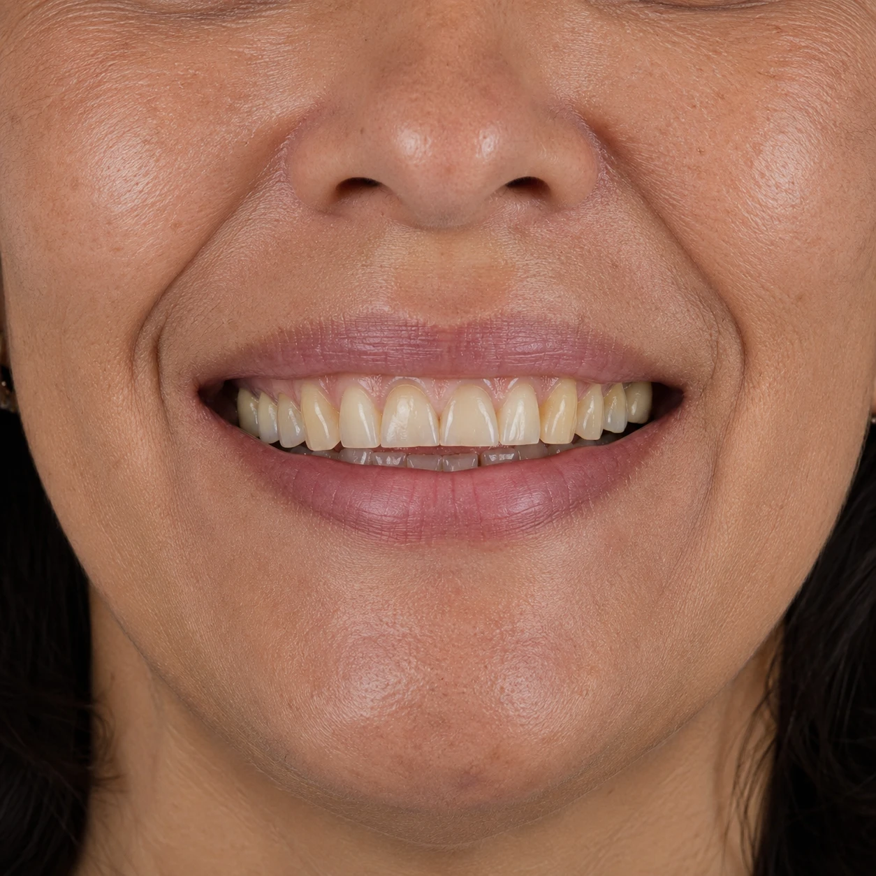 Sorriso antes da reabilitação estética, com dentes amarelados e desgaste generalizado