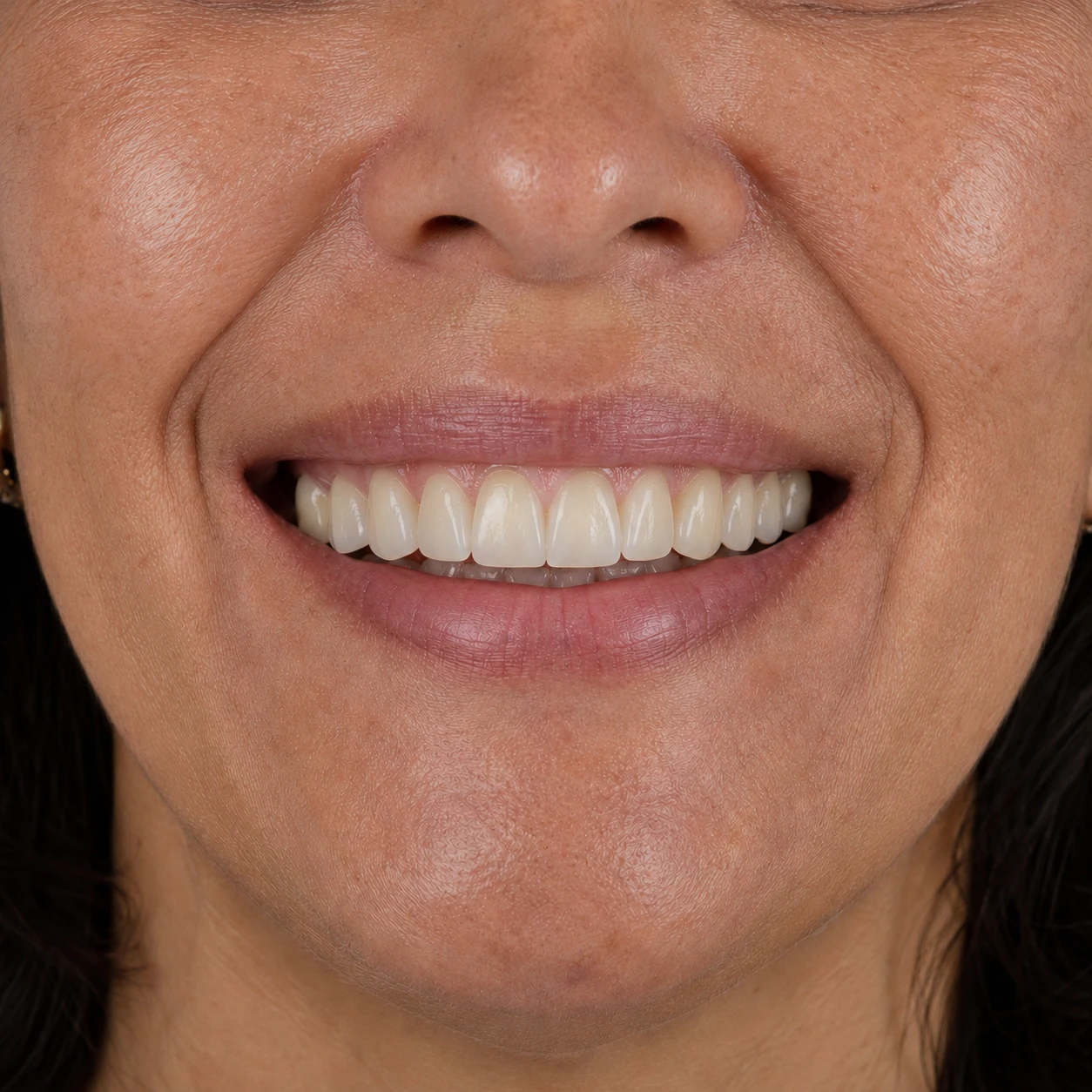 Sorriso depois da reabilitação estética completa, com coroas e facetas em porcelana